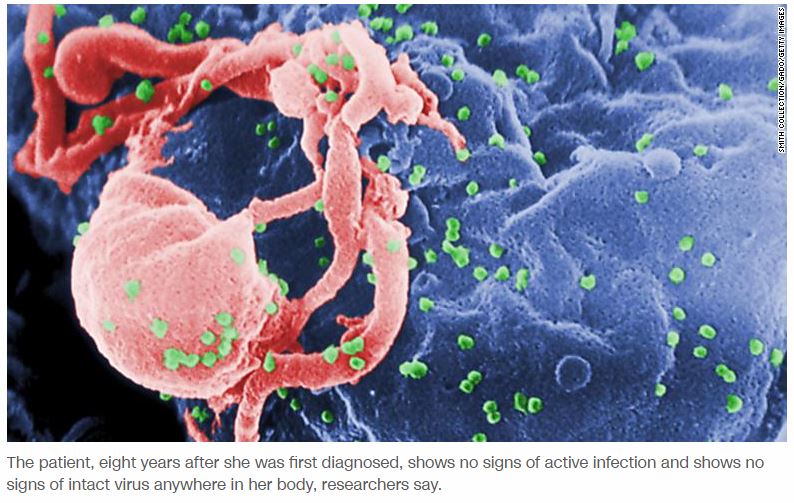 A 2nd HIV patient may have been ‘cured’ of infection without stem cell treatment, in extremely rare case
