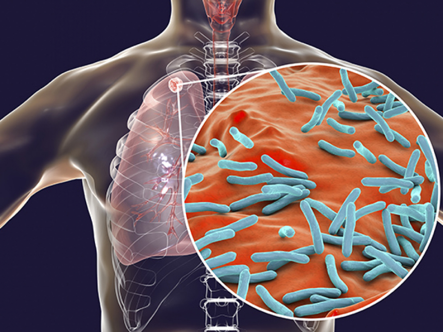 TUBERCULOSIS: What is it?