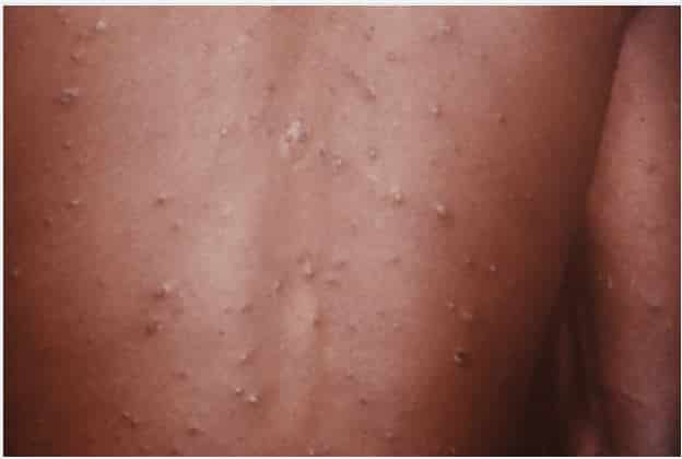 Health ministry in Guyana confirms chickenpox outbreak in prison