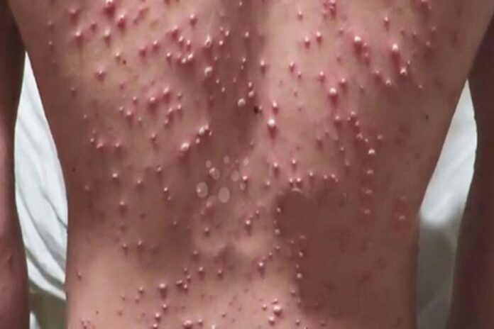 Montserrat health officials warn of spike in chickenpox cases